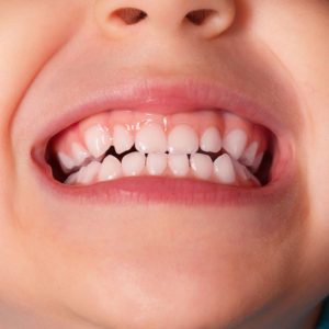 Preventive Dentistry for Children