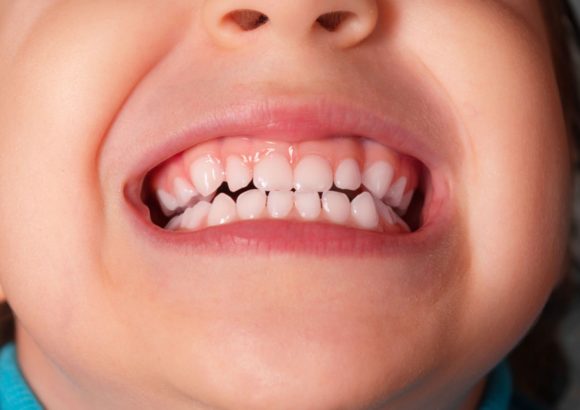 Preventive Dentistry for Children