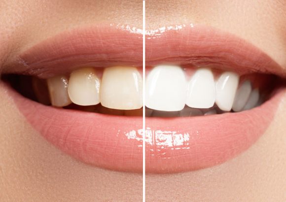 Bleaching