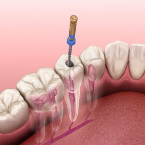 Endodontics