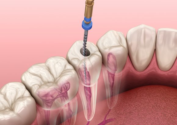 Endodontics