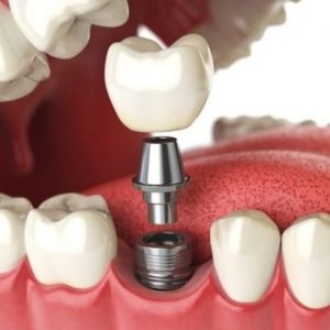 Dental Implantation