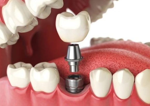 Dental Implantation