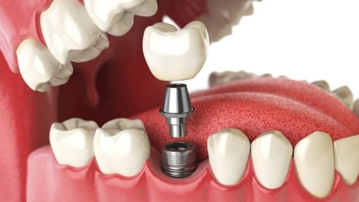 Dental Implantation Dental Implantation