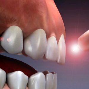 Dental Lazer Treatment Dental Lazer Treatment