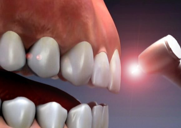 Dental Lazer Treatment