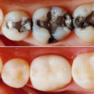 Composite Fillings Composite Fillings