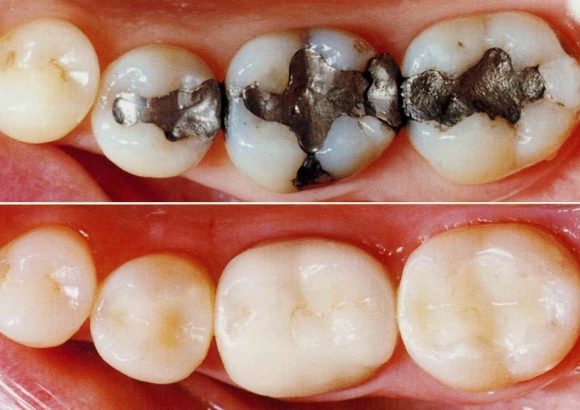 Composite Fillings