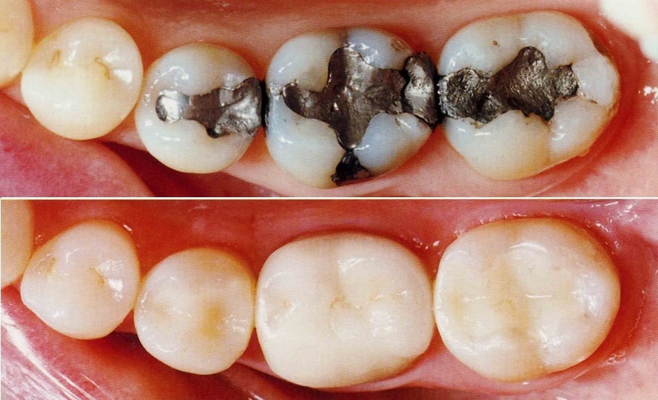 Composite Fillings Composite Fillings