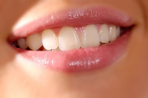 Laminate Veneers