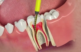 Root Canal Treatments
